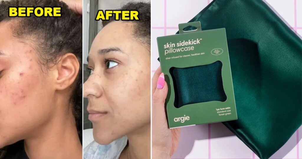 This Clinically Analyzed Vegan Pillowcase Is Designed To Help With Acne — This Is How It Works